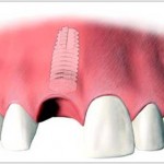 Implant placed