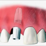 Dental Implant abutment attached Magherafelt Northern Ireland