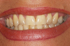 Tooth whitening Magherafelt