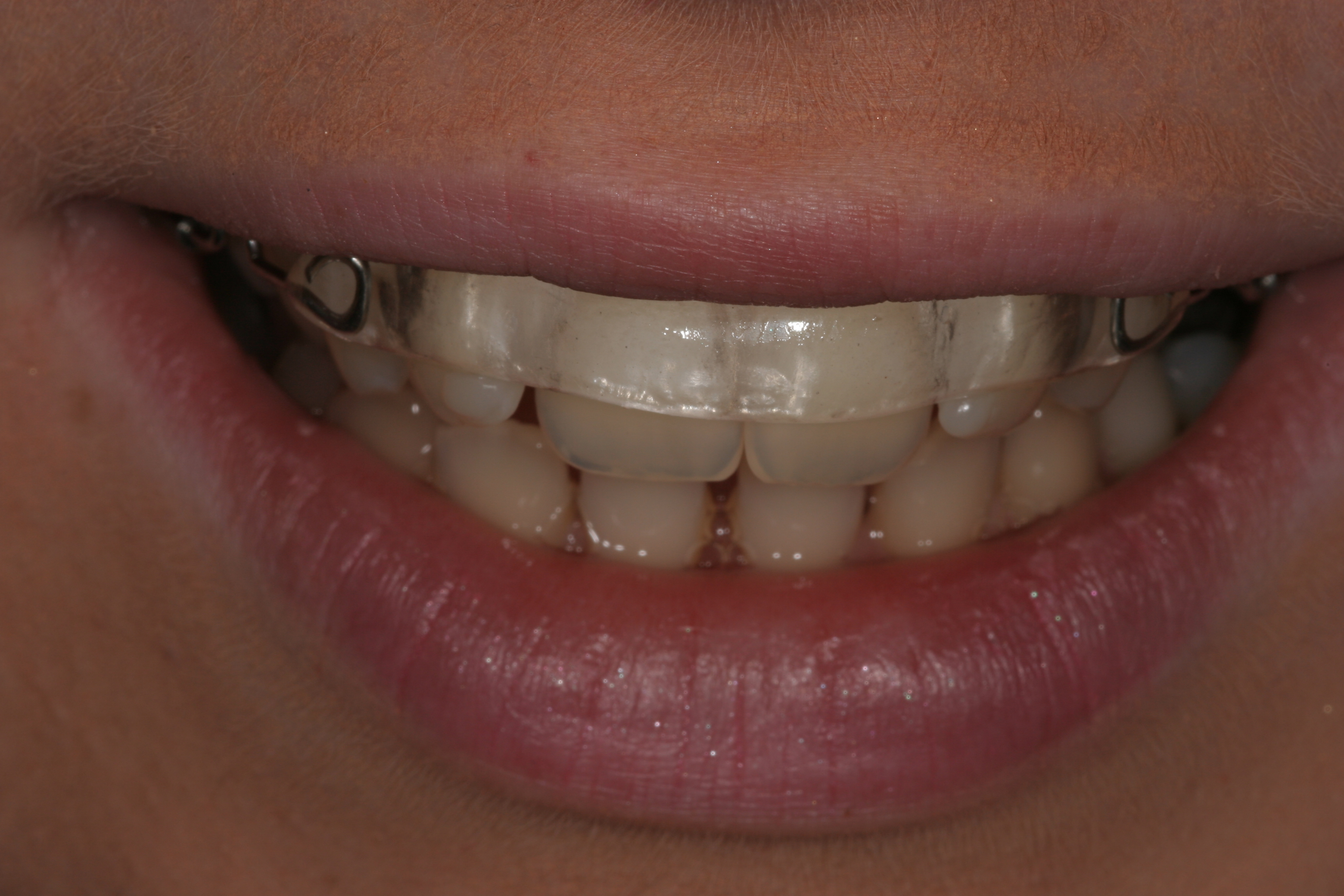 Inman Aligner Corry Dental Care